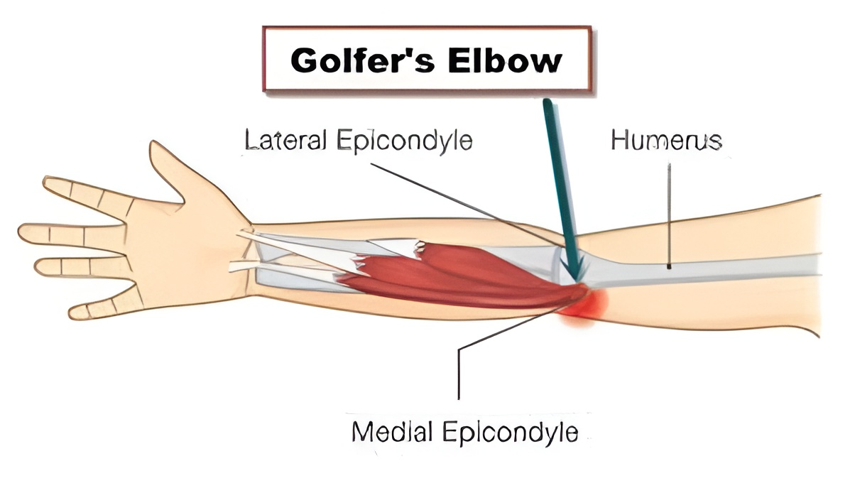What is Golfer’s Elbow?